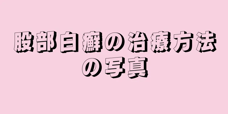 股部白癬の治療方法の写真
