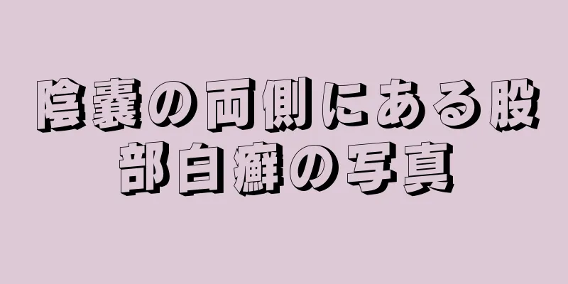 陰嚢の両側にある股部白癬の写真