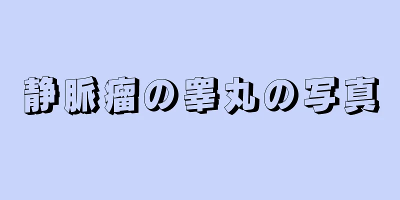 静脈瘤の睾丸の写真