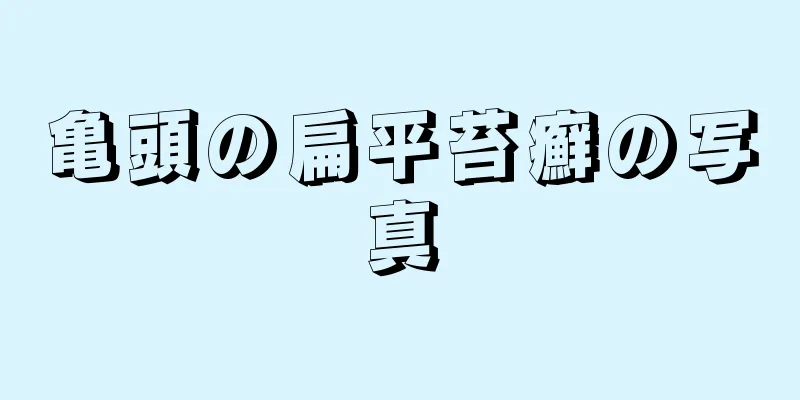 亀頭の扁平苔癬の写真