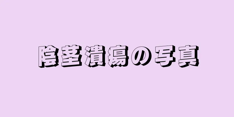 陰茎潰瘍の写真