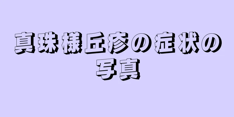 真珠様丘疹の症状の写真