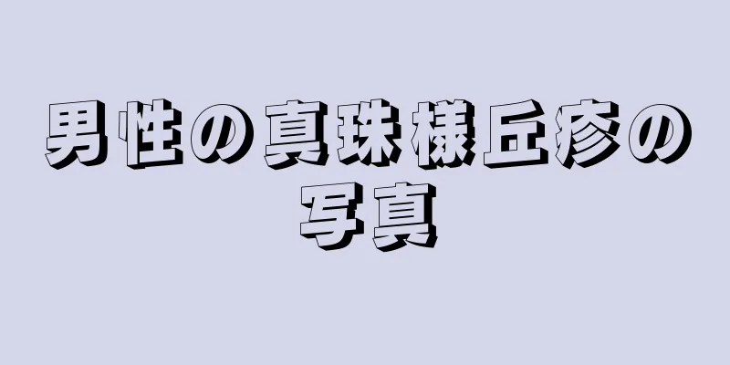 男性の真珠様丘疹の写真