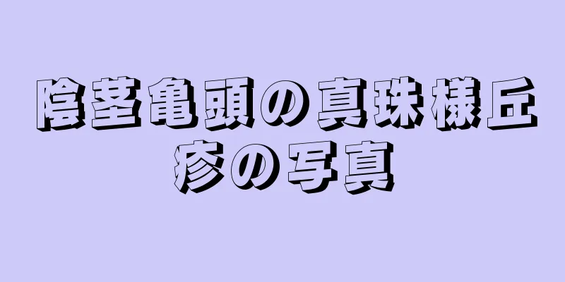 陰茎亀頭の真珠様丘疹の写真