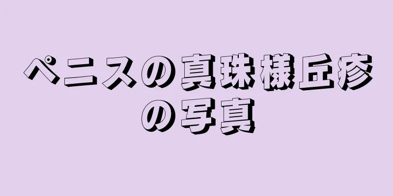 ペニスの真珠様丘疹の写真