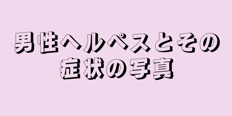 男性ヘルペスとその症状の写真