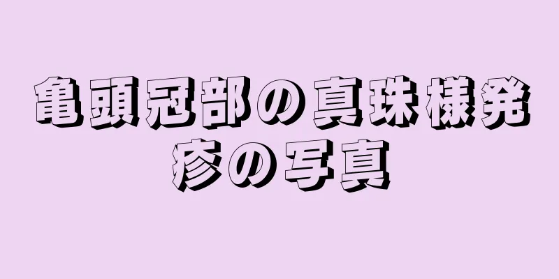 亀頭冠部の真珠様発疹の写真