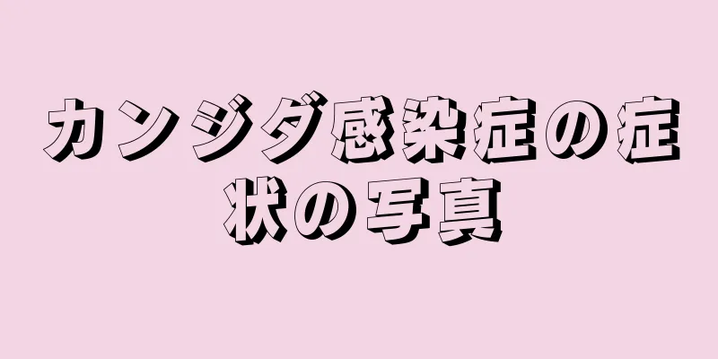 カンジダ感染症の症状の写真